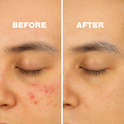 High Frequency Skin Therapy Wand