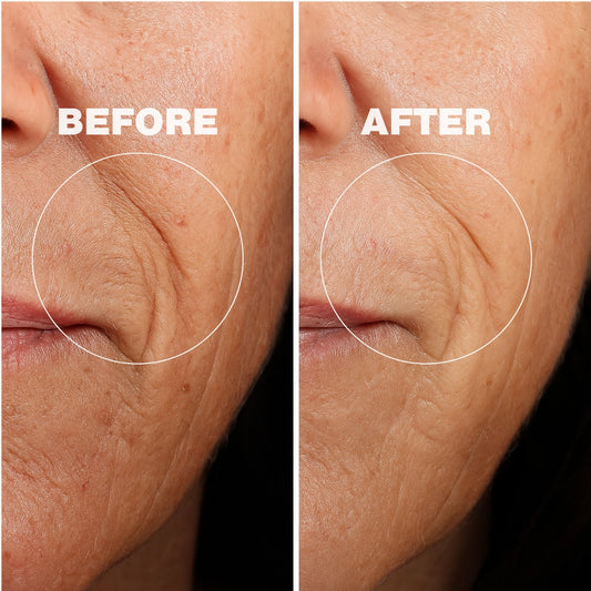 High Frequency Skin Therapy Wand